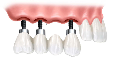 implantologia dentale.png