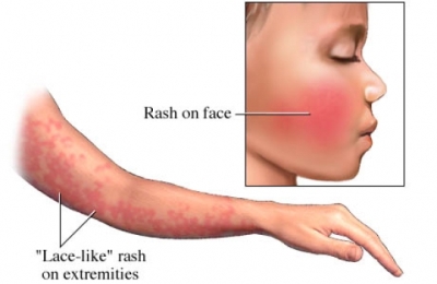 infezione da parvovirus