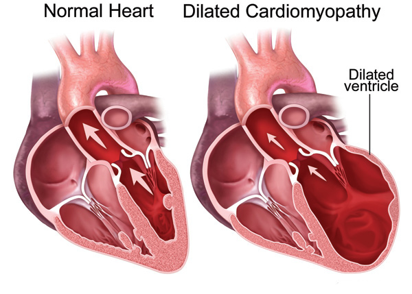 Cardiomiopatia dilatativa