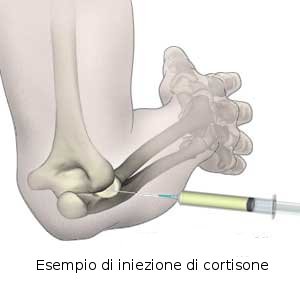 iniezioni di cortisone.jpg