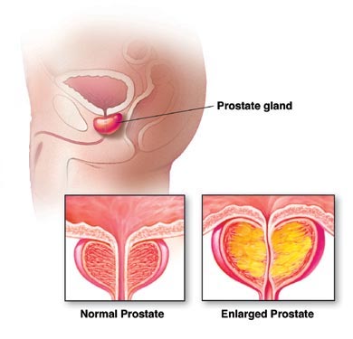 ce este util pentru prostatita ma doare in zona rinichiului stang