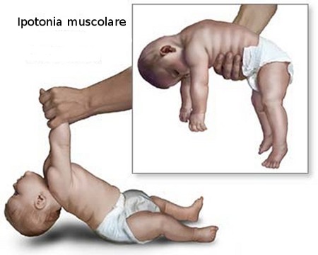 ipotonia sindrome di prader willi.jpg