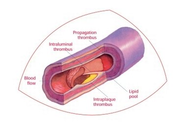 ischemia e danno alle arterie
