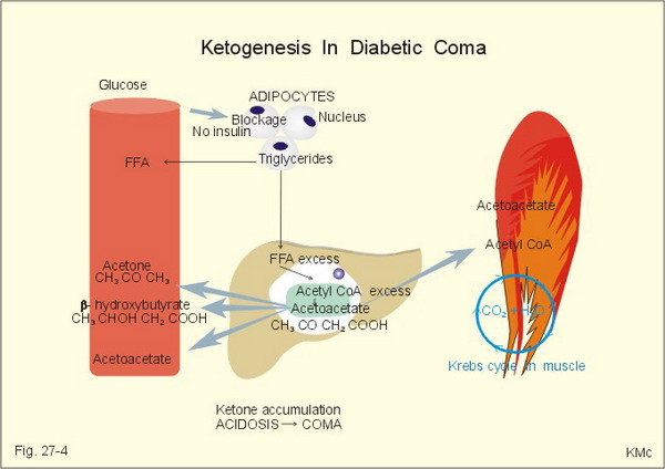 ketoacidosi.jpg