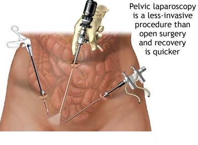 laparoscopia pelvica.jpg