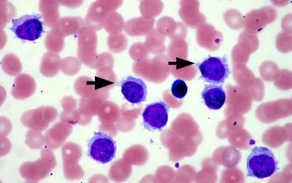 Leucemia a cellule capellute : sintomi, cause, diagnosi e cure