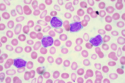 Leucemia mieloide acuta : sintomi, cause, diagnosi e cure