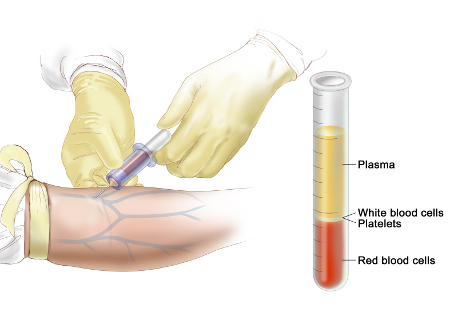 leucemia linfocitica acuta-esame del sangue.jpg