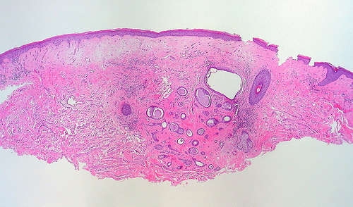 Lichen sclerosus: vediamo di cosa si tratta