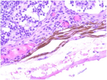 Biopsia del linfonodo sentinella : chirurgia, analgesia e utilizzo