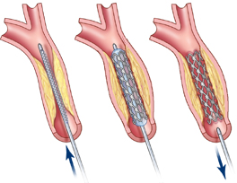 lo stent.jpg