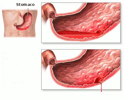 lo stomaco ulcerato1.gif