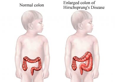 malattia di Hirschsprung.jpg