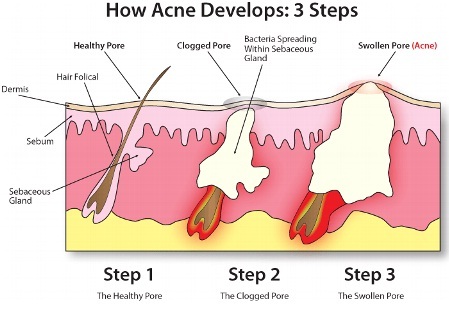 Acne: un problema fastidioso