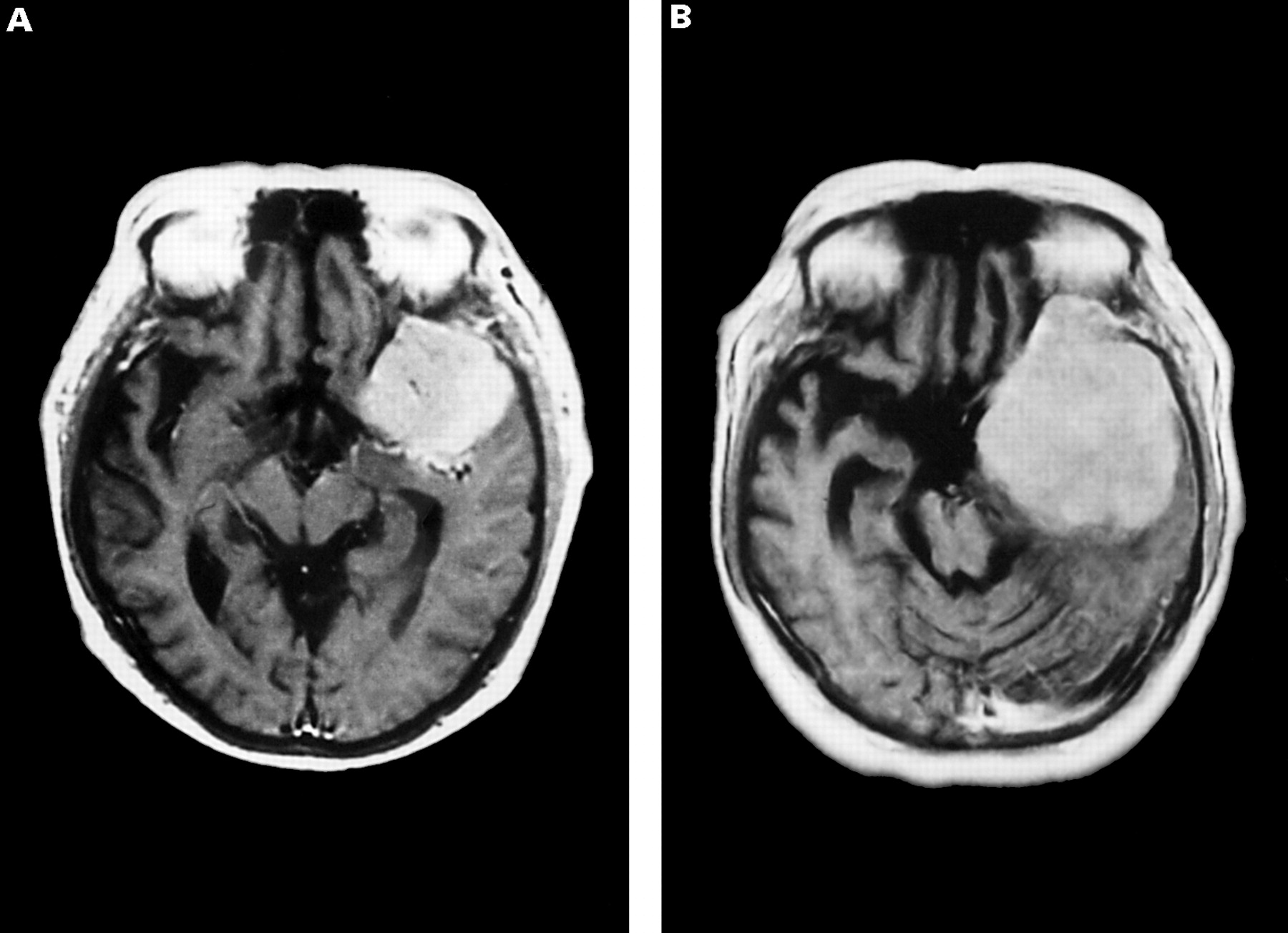 meningioma21.jpg