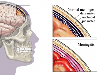 meningite