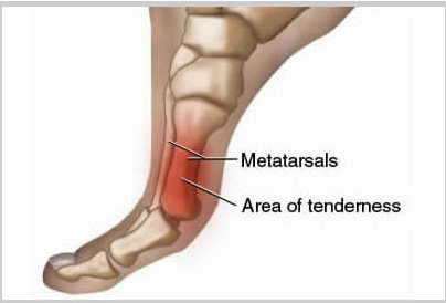 metatarsalgia.jpg
