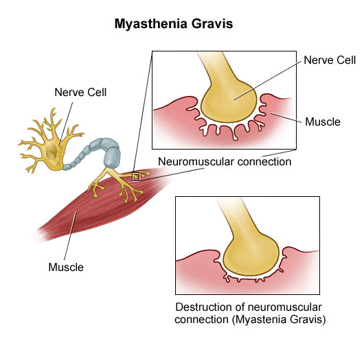 miastenia gravis.gif