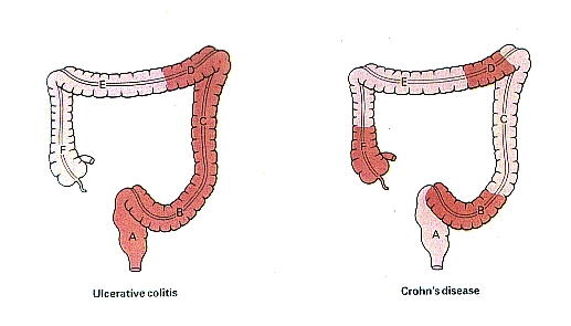 morbo di crohn.jpg