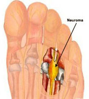 neuroma di Morton1.jpg