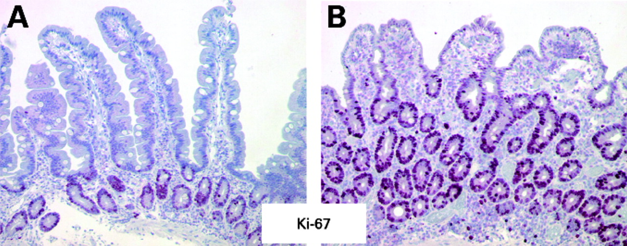 norovirus biopsia duodenale1.jpg