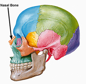Setto nasale deviato