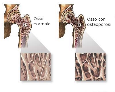 osso normale e osso con osteoporosi.jpg