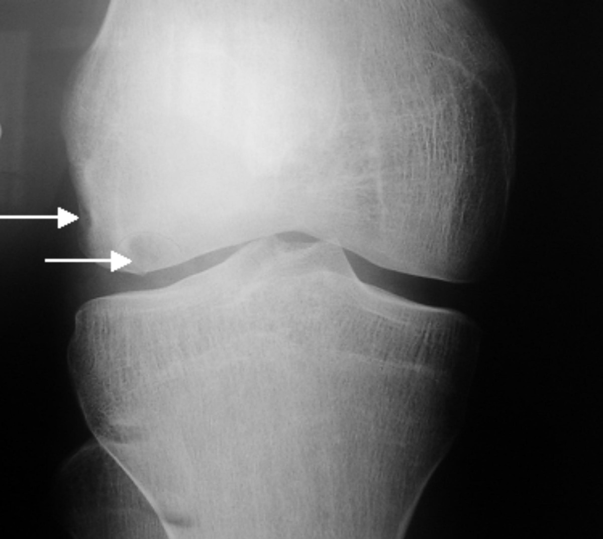 osteocondrite dissecante1.jpg