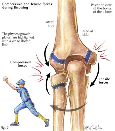 osteocondrite dissecante21.jpg