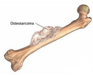 osteosarcoma.jpg