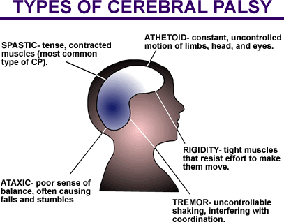 paralisi cerebrale.gif