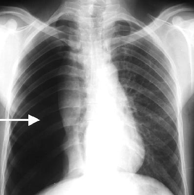 pneumotorace totale1.gif