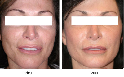 prima edopo laser skin resurfacing.jpg