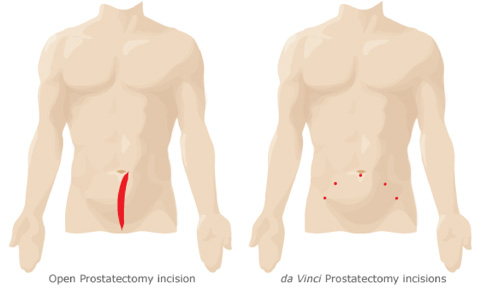 Prostatectomia a cielo aperto : procedura, rischi, convalescenza e benefici