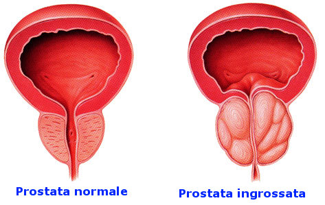 prostatite