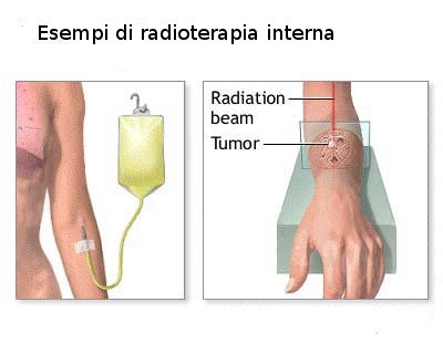 radioterapia interna.jpg