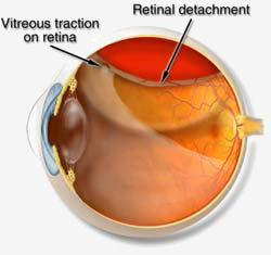 retina staccata.jpg