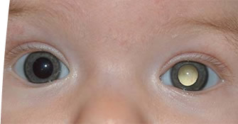 retinoblastoma1.jpg