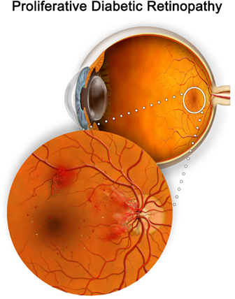 retinopatia proliferativa.jpg