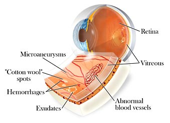 retinopatia.jpg