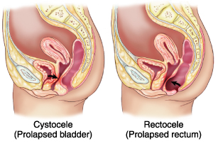 Rettocele: sintomi, cause, diagnosi e terapie