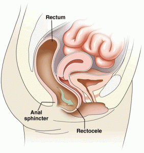 rettocele21.gif