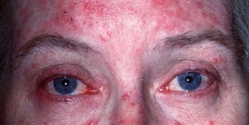 rosacea degli occhi 21.jpeg