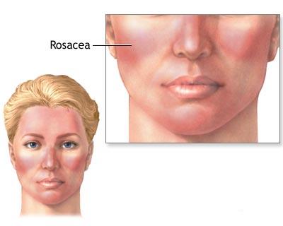 rosacea e zone di massimo interesse1.jpg