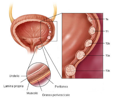 schema del cancro della vescica.jpg