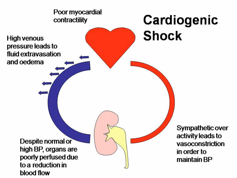 Lo shock cardiogeno: sintomi e pericoli