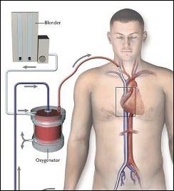 Sindrome da distress respiratorio acuto (ARDS) : sintomi, cause, complicazioni e cure