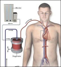 sindrome da distress respiratorio acuto1.jpg