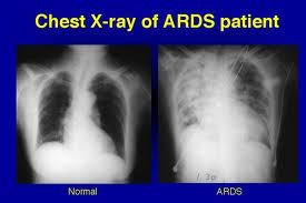 sindrome da distress respiratorio acuto21.jpg