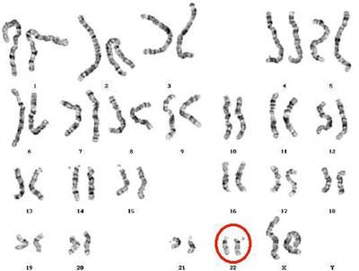 sindrome di DIGeroge-cromosomi.jpg